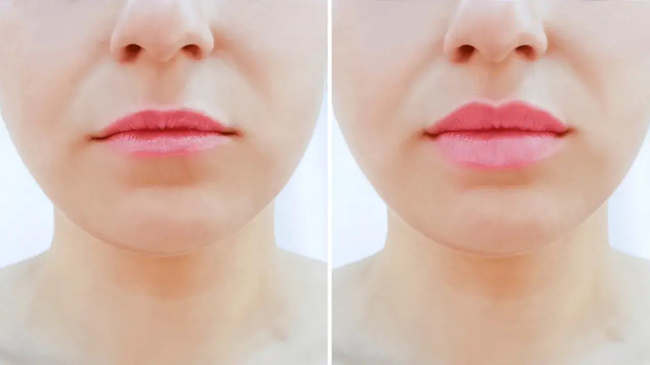 Przed i po zabiegu botox lip flip. Usta stały się pełniejsze i bardziej zdefiniowane.