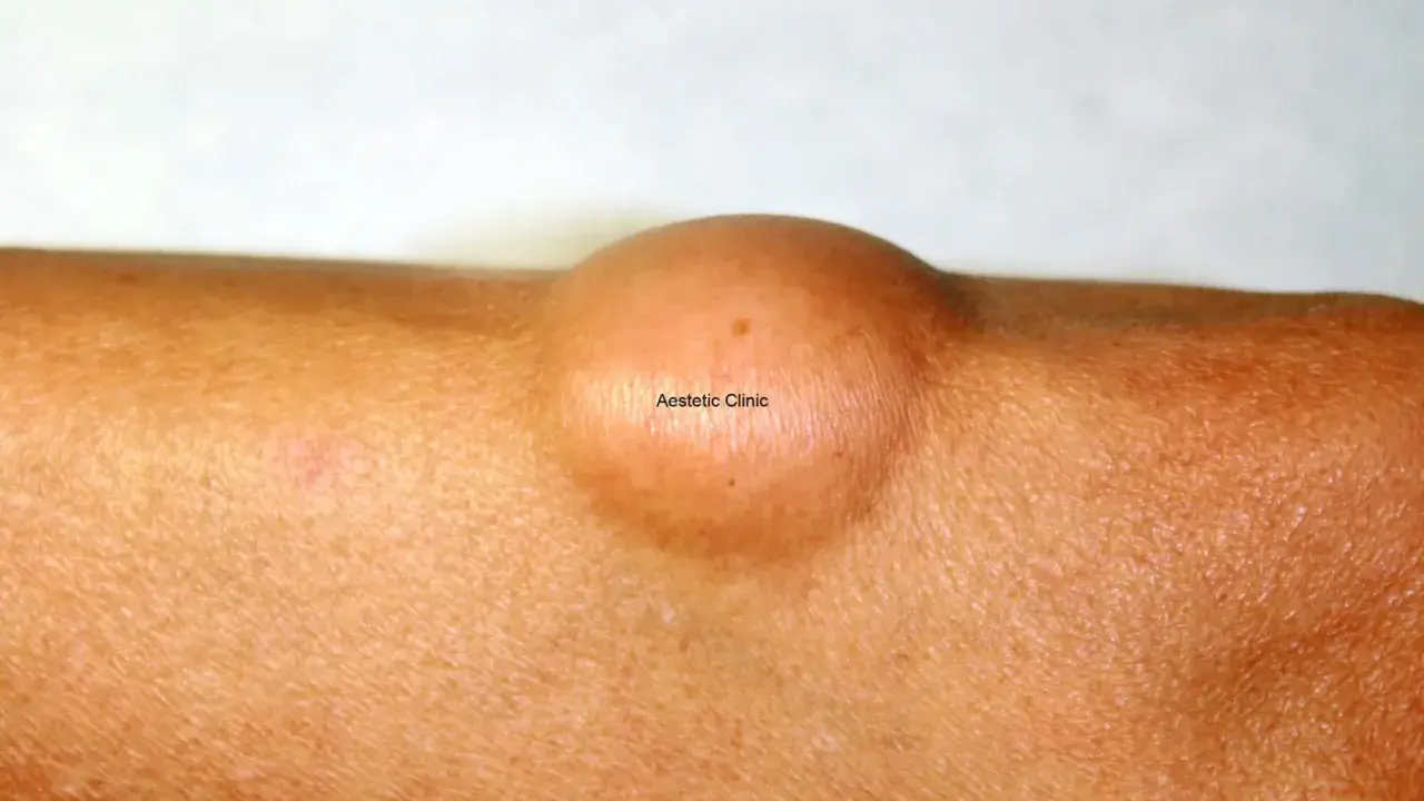 Widoczny na skórze łagodny tłuszczak (lipoma) – okrągłe, cieliste zgrubienie.
