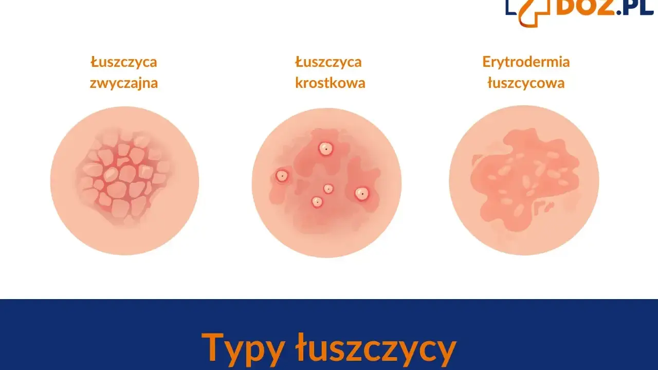 Ilustracje przedstawiają różne typy łuszczycy skóry: łuszczycę zwyczajną, krostkową i erytrodermię łuszczycową.