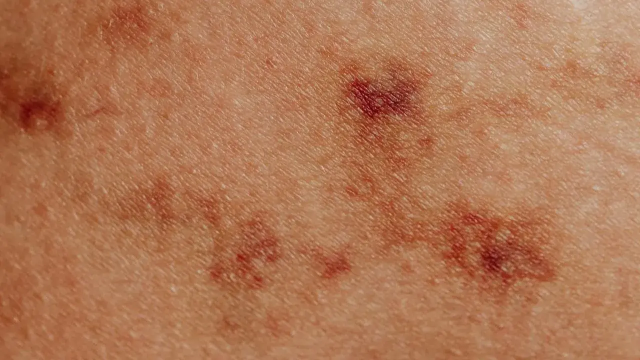 Zbliżenie na skórę z ciemniejszymi przebarwieniami, przypominającymi swędzące krosty na ciele.