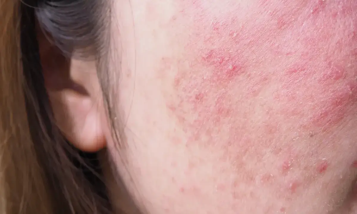 Skóra na policzku z zaczerwienieniem i suchymi plamami, wskazującymi na podrażnienie lub problem dermatologiczny.