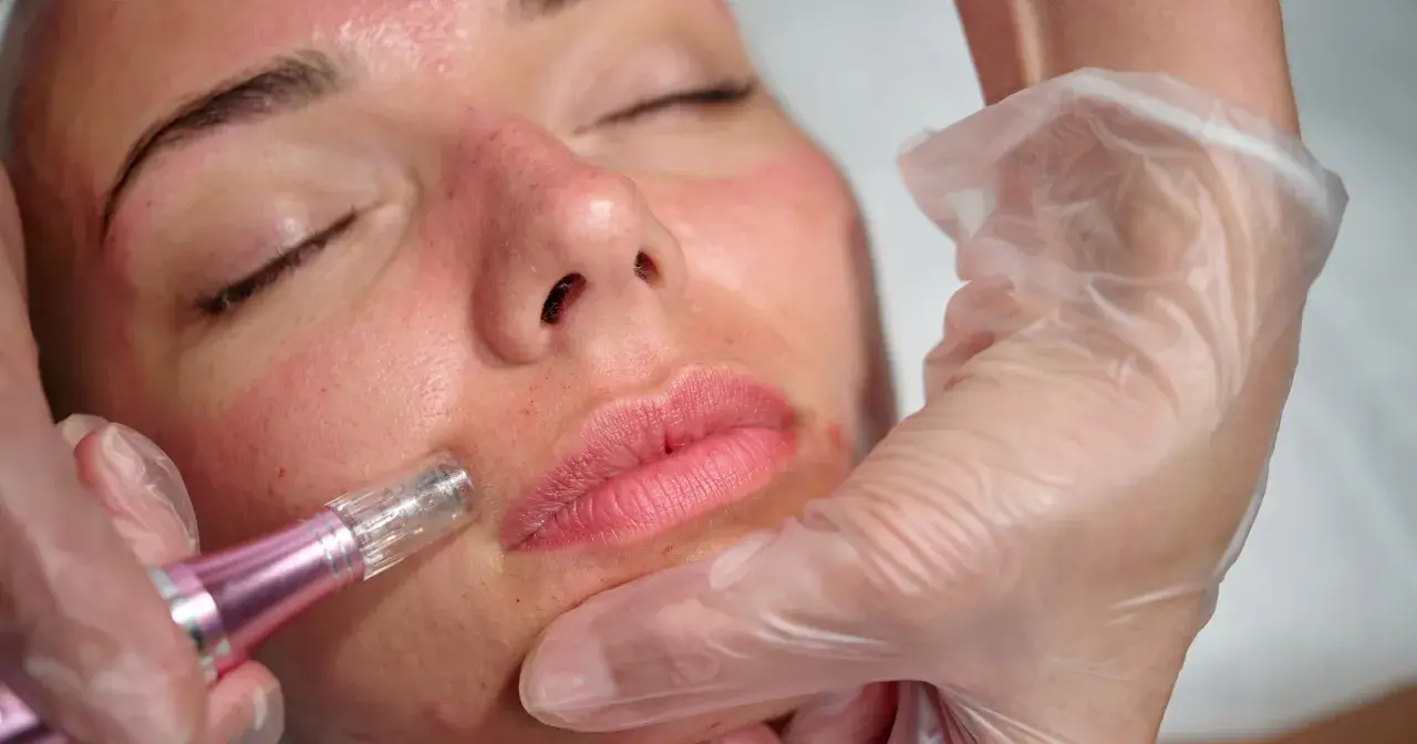 Zabieg dermapenem na twarz, widoczne zaczerwienienie i mikronakłucia. Oczekiwane dermapen efekty to odmłodzona i wygładzona skóra.