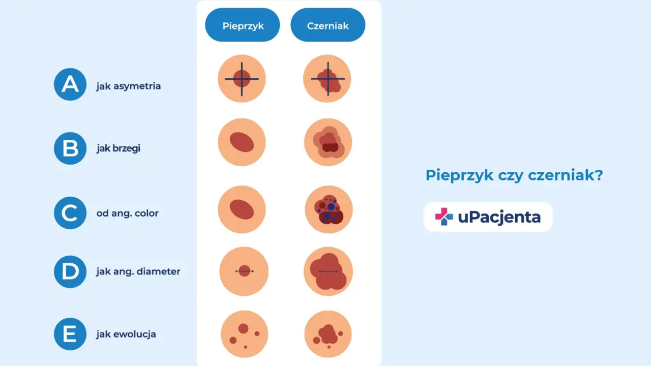 Porównanie pieprzyka i czerniaka: asymetria, brzegi, kolor, średnica i ewolucja. Czy czerniak swędzi? Sprawdź różnice.