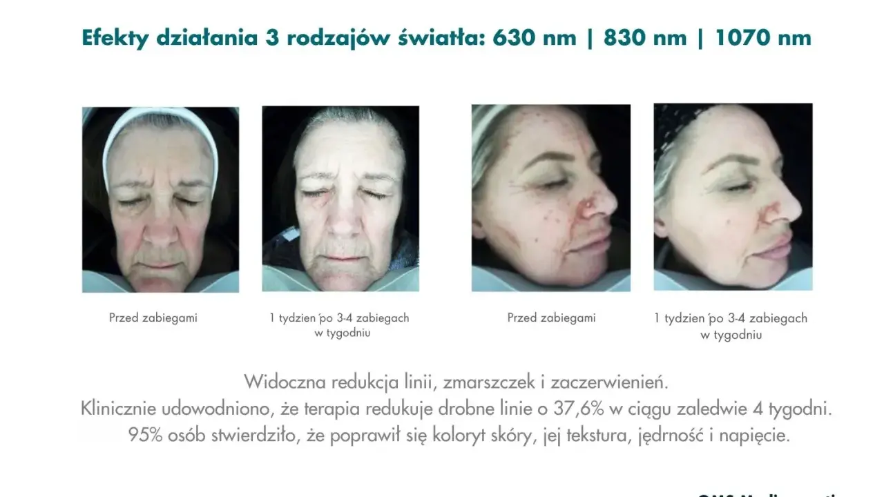 Przed i po zabiegach światłoterapią: czerwone światło na twarz redukuje zmarszczki i zaczerwienienia, poprawiając koloryt i teksturę skóry.