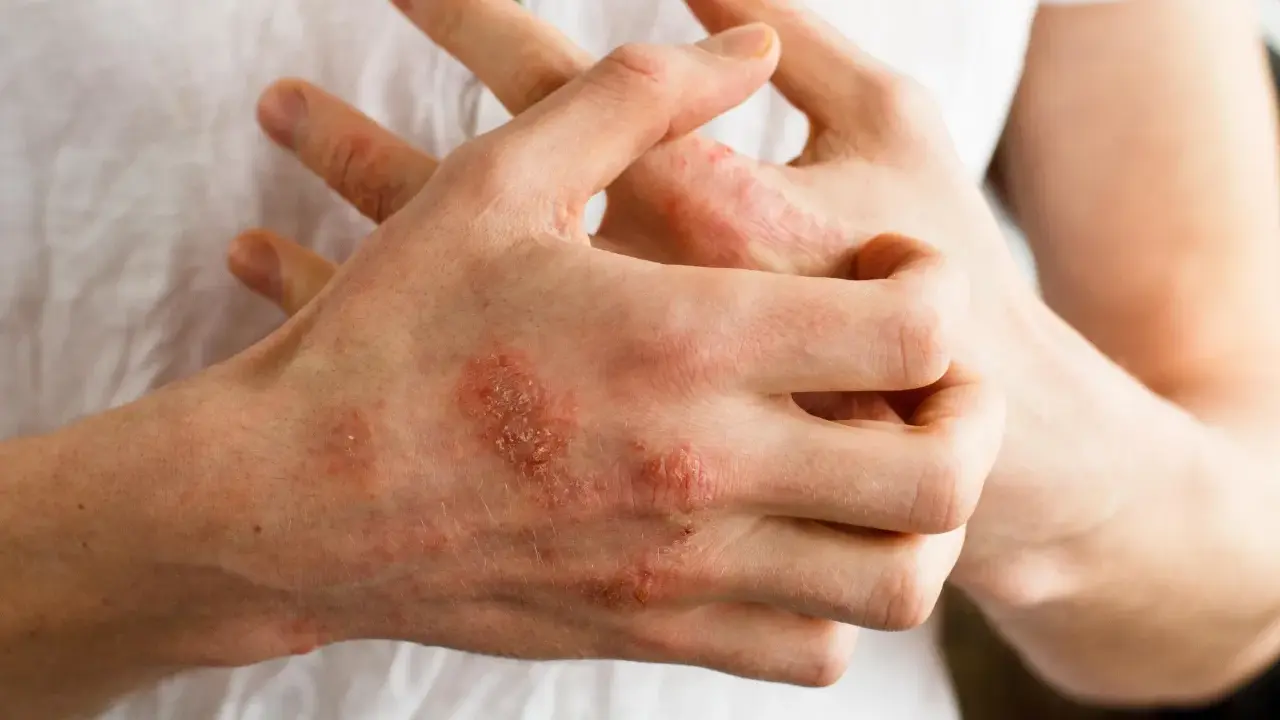 Dłonie z widocznymi zmianami skórnymi, zaczerwienieniem i łuszczeniem, sugerującymi **przeczosy** lub inne schorzenie dermatologiczne.