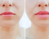 Przed i po zabiegu botox lip flip. Usta stały się pełniejsze i bardziej zdefiniowane.
