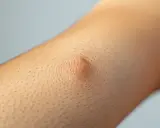 Widoczny tłuszczak na udzie, niewielki, okrągły guzek pod skórą, otoczony porami i włoskami.