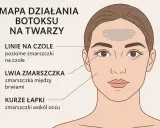 Mapa działania botoksu na twarzy: miejsca wstrzyknięć na czole, między brwiami i wokół oczu.