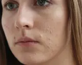 Młoda kobieta z niedoskonałościami na twarzy, być może stosująca sudocrem na twarz.