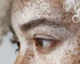 Zbliżenie na twarz z widocznym **vitiligo**, gdzie plamy depigmentacji przeplatają się z piegami. Jasne, kręcone włosy otaczają twarz.