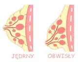 Ilustracja porównuje jędrne i obwisłe piersi, pokazując różnice w ich budowie.