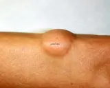 Widoczny na skórze łagodny tłuszczak (lipoma) – okrągłe, cieliste zgrubienie.