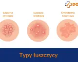 Ilustracje przedstawiają różne typy łuszczycy skóry: łuszczycę zwyczajną, krostkową i erytrodermię łuszczycową.