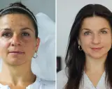 Porównanie twarzy kobiety przed i po zabiegu: skóra z niedoskonałościami i po wygładzeniu.