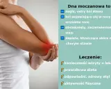 Dna moczanowa: objawy skórne, ból stawu, obrzęk. Leczenie: wizyta u lekarza, dieta, styl życia, aktywność fizyczna.