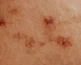 Zbliżenie na skórę z ciemniejszymi przebarwieniami, przypominającymi swędzące krosty na ciele.