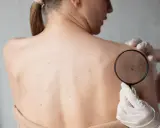 Dermatolog bada pieprzyk na plecach pacjentki przez lupę, oceniając potencjalną dermatozę.