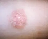 Różowa, łuszcząca się plama na skórze, przypominająca łupież różowy Giberta.