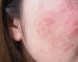 Skóra na policzku z zaczerwienieniem i suchymi plamami, wskazującymi na podrażnienie lub problem dermatologiczny.