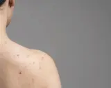 Trądzik na plecach? Poznaj skuteczne metody na gładką skórę!