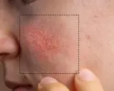 Cera naczynkowa: Jaki peeling wybrać, by nie zaszkodzić?