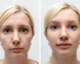 Przed i po zabiegu: skóra twarzy przed i po zastosowaniu osocza bogatopłytkowego. Wygładzone zmarszczki, odżywiona cera.