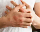 Dłonie z widocznymi zmianami skórnymi, zaczerwienieniem i łuszczeniem, sugerującymi **przeczosy** lub inne schorzenie dermatologiczne.