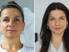 Porównanie twarzy kobiety przed i po zabiegu: skóra z niedoskonałościami i po wygładzeniu.