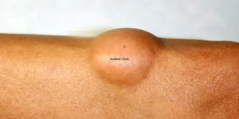 Widoczny na skórze łagodny tłuszczak (lipoma) – okrągłe, cieliste zgrubienie.