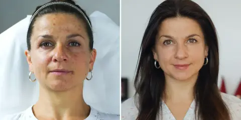 Porównanie twarzy kobiety przed i po zabiegu: skóra z niedoskonałościami i po wygładzeniu.
