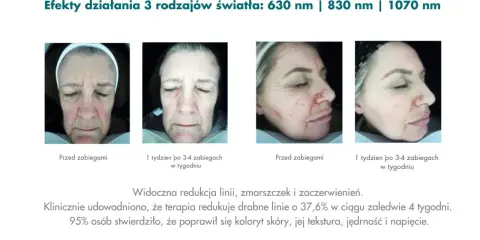 Przed i po zabiegach światłoterapią: czerwone światło na twarz redukuje zmarszczki i zaczerwienienia, poprawiając koloryt i teksturę skóry.
