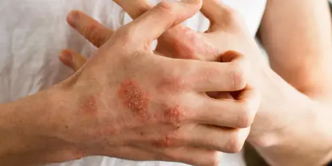 Dłonie z widocznymi zmianami skórnymi, zaczerwienieniem i łuszczeniem, sugerującymi **przeczosy** lub inne schorzenie dermatologiczne.