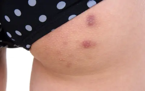 Widoczne krosty na pośladkach, pod czarnymi majtkami w białe kropki. Skóra jest zaczerwieniona i lekko podrażniona.