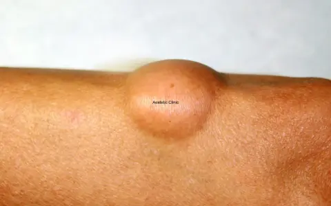 Widoczny na skórze łagodny tłuszczak (lipoma) – okrągłe, cieliste zgrubienie.