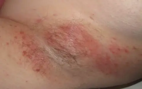 Skóra pod pachami zaczerwieniona, z widocznymi krostkami i łuszczeniem, wskazująca na odparzenia pod pachami.