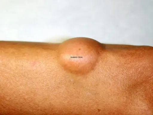 Widoczny na skórze łagodny tłuszczak (lipoma) – okrągłe, cieliste zgrubienie.