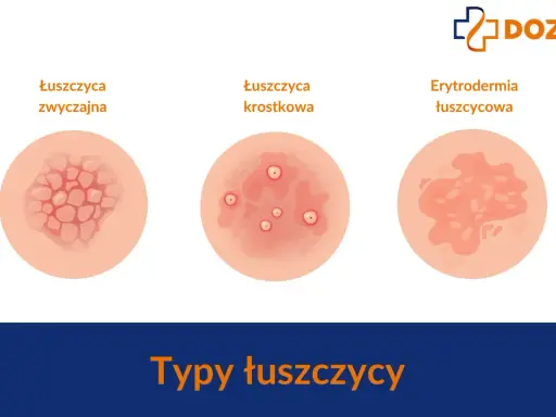 Ilustracje przedstawiają różne typy łuszczycy skóry: łuszczycę zwyczajną, krostkową i erytrodermię łuszczycową.