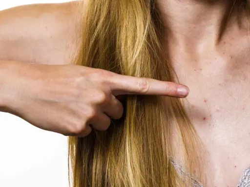 Pryszcze na dekolcie? Jak skutecznie się ich pozbyć poradnik