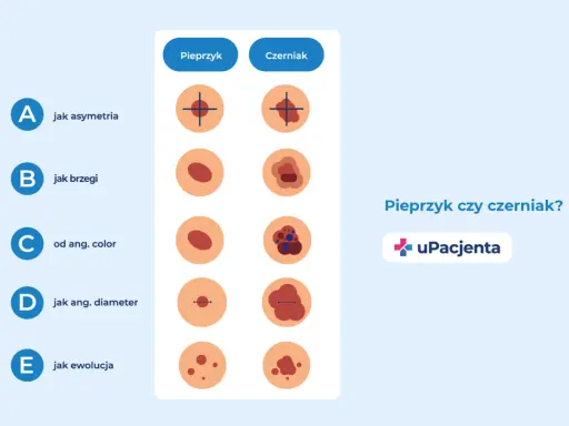 Porównanie pieprzyka i czerniaka: asymetria, brzegi, kolor, średnica i ewolucja. Czy czerniak swędzi? Sprawdź różnice.