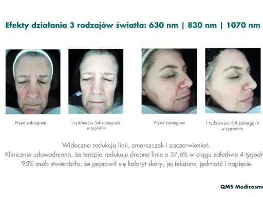 Przed i po zabiegach światłoterapią: czerwone światło na twarz redukuje zmarszczki i zaczerwienienia, poprawiając koloryt i teksturę skóry.