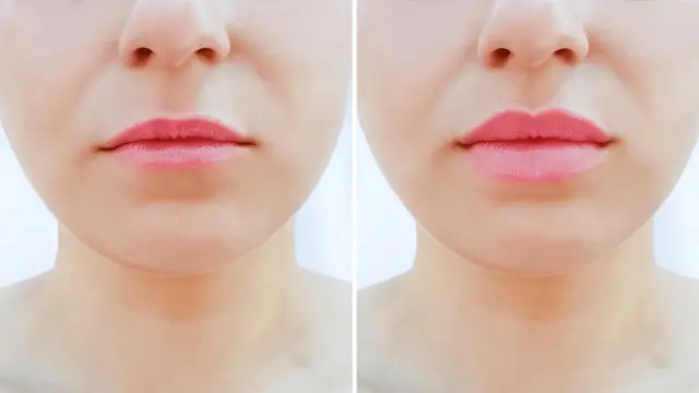 Przed i po zabiegu botox lip flip. Usta stały się pełniejsze i bardziej zdefiniowane.