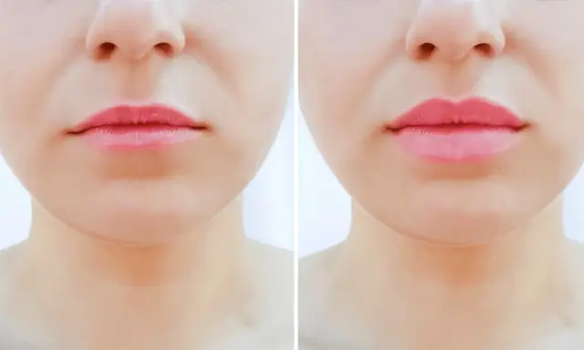 Przed i po zabiegu botox lip flip. Usta stały się pełniejsze i bardziej zdefiniowane.