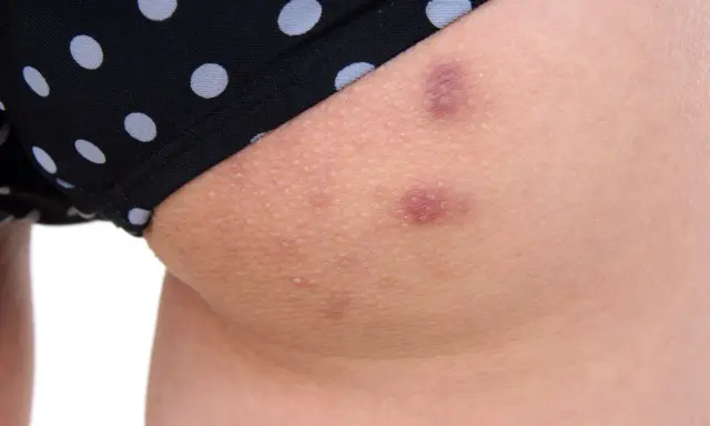 Widoczne krosty na pośladkach, pod czarnymi majtkami w białe kropki. Skóra jest zaczerwieniona i lekko podrażniona.