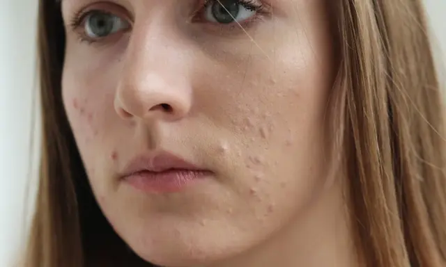 Młoda kobieta z niedoskonałościami na twarzy, być może stosująca sudocrem na twarz.
