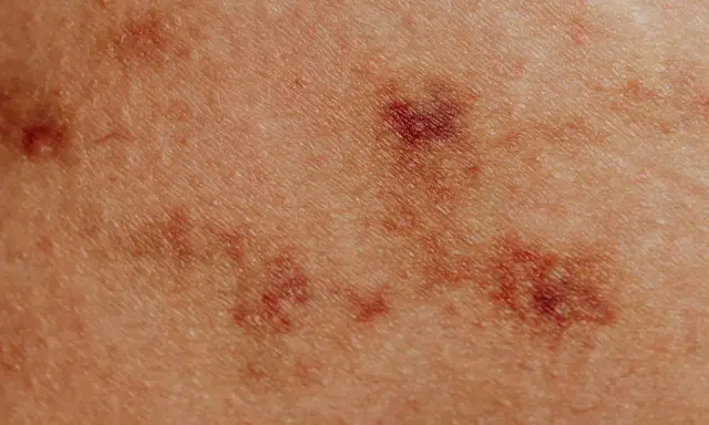 Zbliżenie na skórę z ciemniejszymi przebarwieniami, przypominającymi swędzące krosty na ciele.