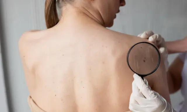 Dermatolog bada pieprzyk na plecach pacjentki przez lupę, oceniając potencjalną dermatozę.