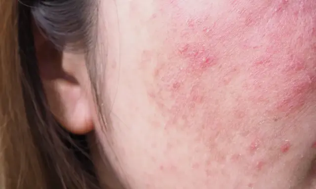 Skóra na policzku z zaczerwienieniem i suchymi plamami, wskazującymi na podrażnienie lub problem dermatologiczny.