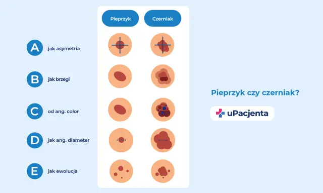 Porównanie pieprzyka i czerniaka: asymetria, brzegi, kolor, średnica i ewolucja. Czy czerniak swędzi? Sprawdź różnice.