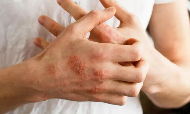 Dłonie z widocznymi zmianami skórnymi, zaczerwienieniem i łuszczeniem, sugerującymi **przeczosy** lub inne schorzenie dermatologiczne.