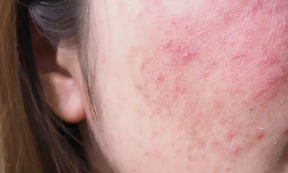 Skóra na policzku z zaczerwienieniem i suchymi plamami, wskazującymi na podrażnienie lub problem dermatologiczny.